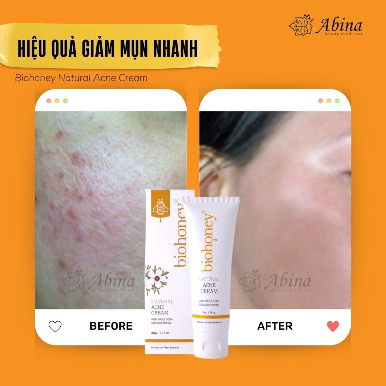 Kem mụn mật ong Manuka Biohoney Natural Acne Cream - Tuýp 50g Kem mụn từ mật ong Manuka Acne Cream Biohoney