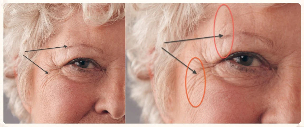 Ngủ sai tư thế hình thành nếp nhăn ngủ