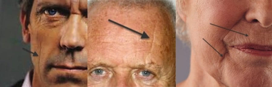 Ngủ sai tư thế hình thành nếp nhăn ngủ (Sleep wrinkles)