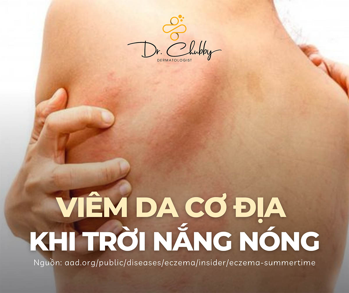 Viem da co dia khi troi nang nong