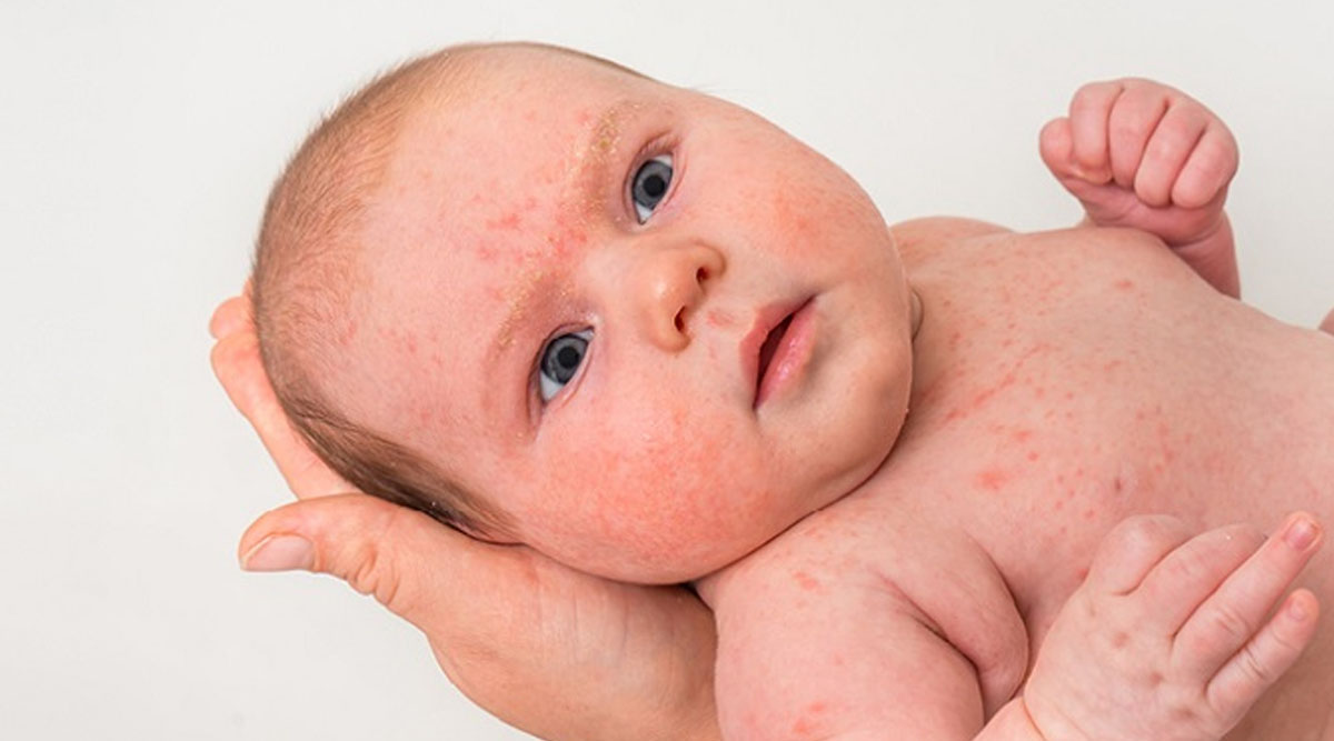 Viem da co dia o tre em Cham sua