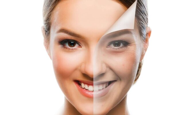 Peel Enzyme - Phương pháp thay da hiệu quả