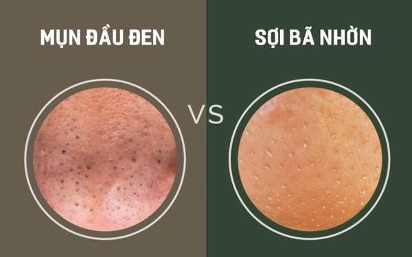 Phân biệt mụn đầu đen và sợi bã-nhờ