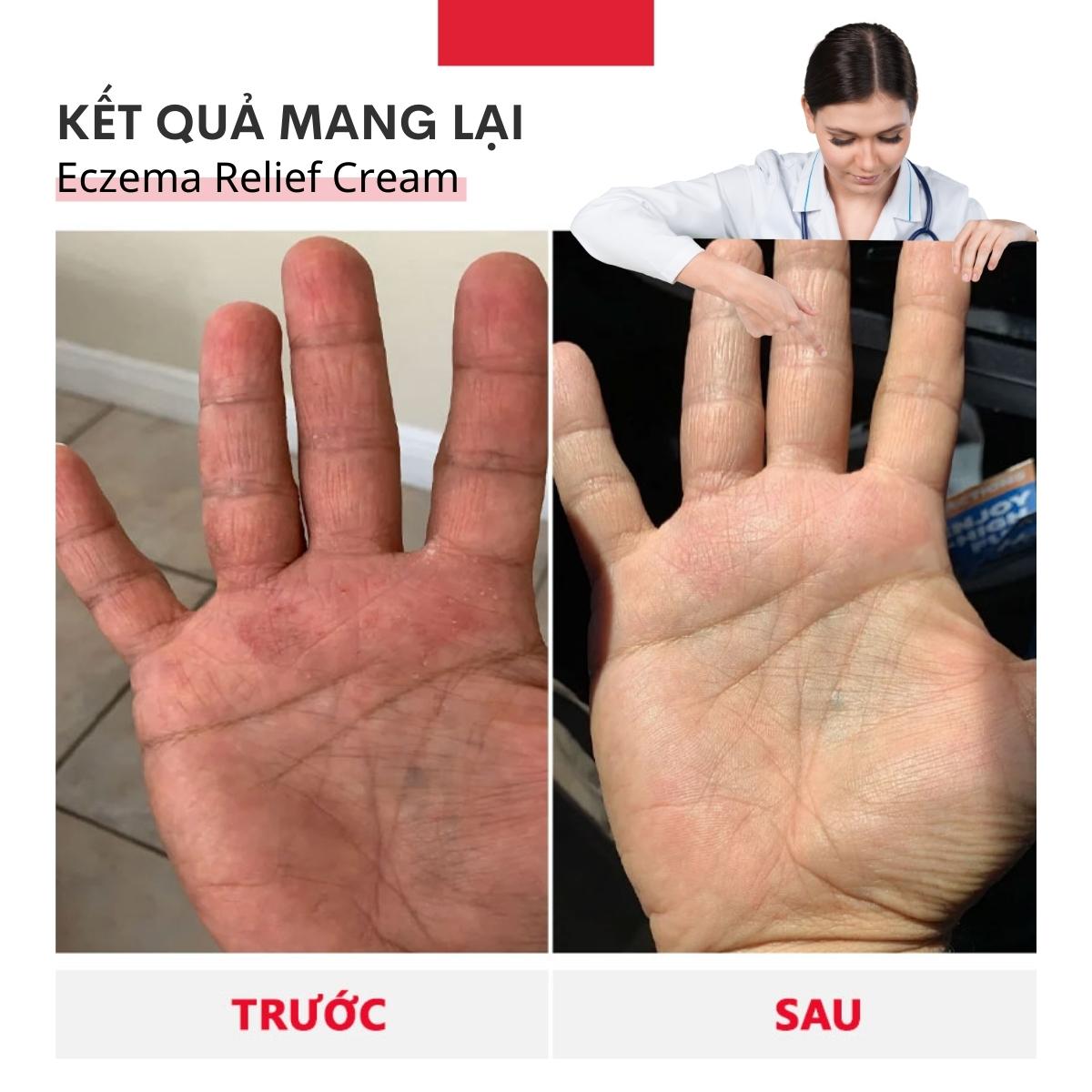 Kem trị chàm da Lavior Relief Eczema 