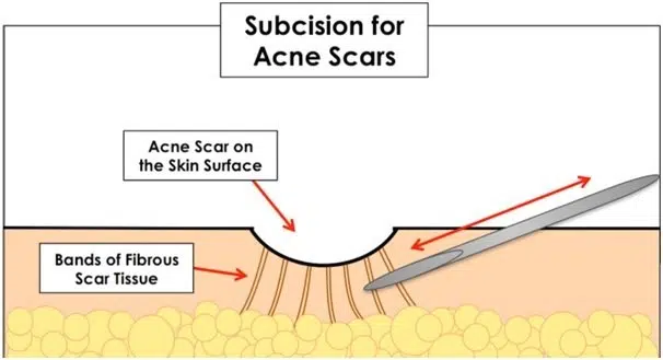 Cơ Địa Sẹo Lồi Có Trị Sẹo Rỗ Được Không? Chuyên Gia Giải Đáp Subcision (Bóc tách sẹo)