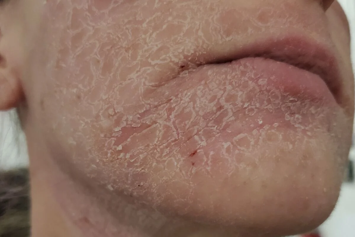 Da Ngứa Sần, Nám Càng Trị Càng Đậm – Cảnh Báo Nhiễm Corticoid & Cách Xử Lý Đúng da bong tróc