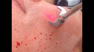 Cơ Địa Sẹo Lồi Có Trị Sẹo Rỗ Được Không? Chuyên Gia Giải Đáp fractional CO2 laser