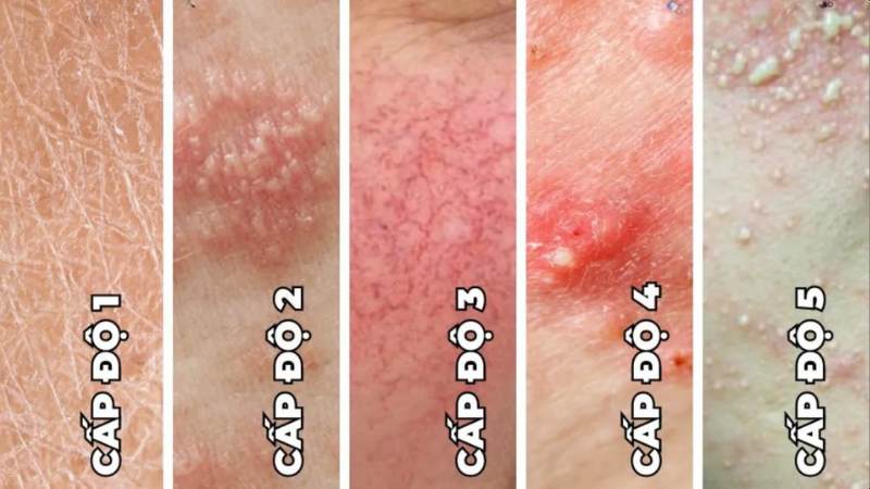 Da Ngứa Sần, Nám Càng Trị Càng Đậm – Cảnh Báo Nhiễm Corticoid & Cách Xử Lý Đúng mức độ nhiễm corticoid