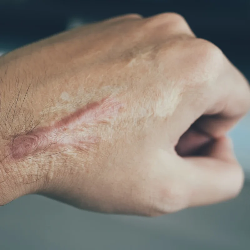 Cơ Địa Sẹo Lồi Có Trị Sẹo Rỗ Được Không? Chuyên Gia Giải Đáp sẹo lồi