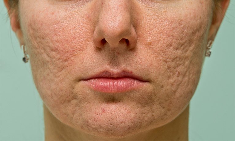 Cơ Địa Sẹo Lồi Có Trị Sẹo Rỗ Được Không? Chuyên Gia Giải Đáp sẹo rỗ
