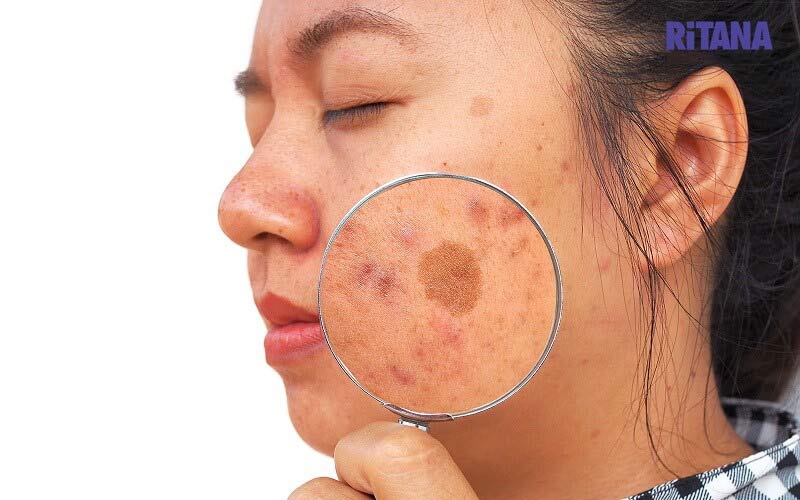 tiền sử nám chân sâu