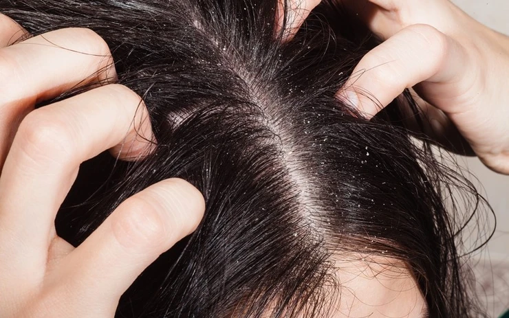 DA ĐẦU BẾT NHƯ CHƯA GỘI – VẤN ĐỀ BỆNH LÝ HAY ĐƠN THUẦN LÀ THÓI QUEN? viêm da tiết bã ở da đầu