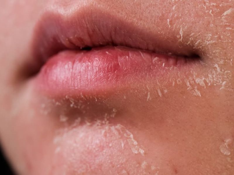 retinol gây bong da